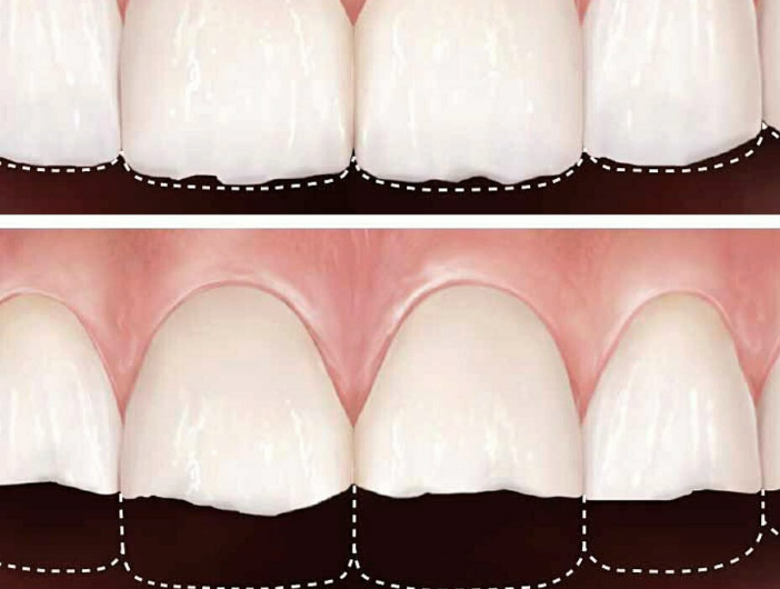 persona-observando-desgaste-dental-en-dientes-delanteros