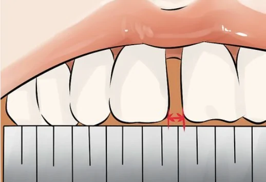 ¿Por qué aparece un espacio entre dientes que antes no existía?