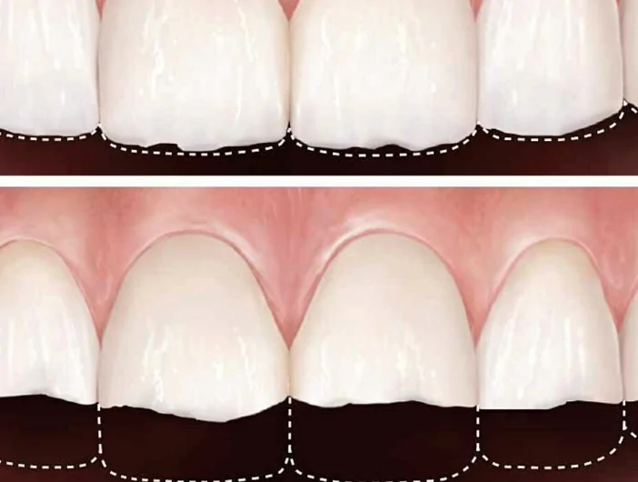 ¿Por qué tus dientes parecen cada vez más cortos? El desgaste que muchas personas no detectan