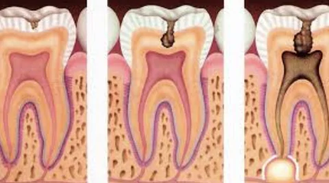 ¿Puede aparecer una caries debajo de un empaste sin que te des cuenta?