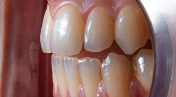 ¿Por qué la punta de algunos dientes empieza a verse transparente?